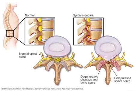 Spinal Stenosis is a common cause of low back pain and sciatica - Capitol  Pain Institute