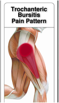 Trochanteric Bursitis