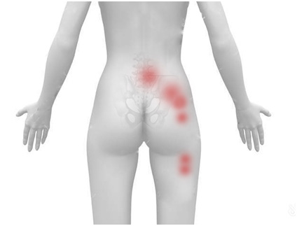 procedure Evaluering slap af Sacroilitis